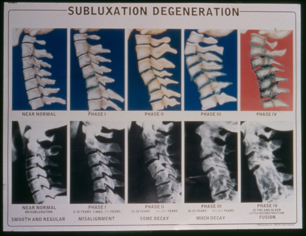 4 Phases of Subluxation Degeneration
