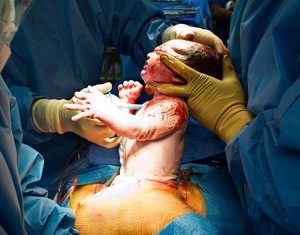C-section